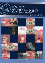 必ず上達ソケットプリザベーション：インプラント初心者でもできる骨造成の書影